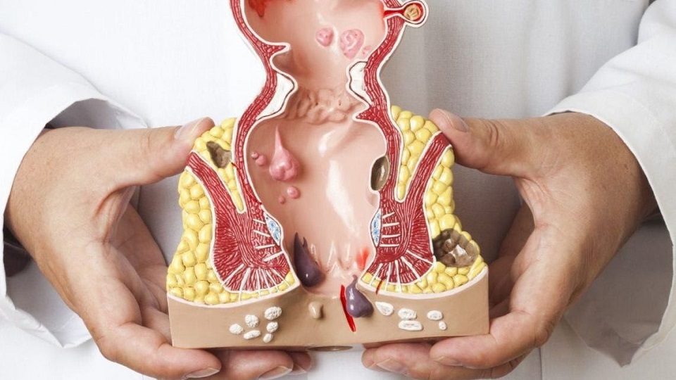 dış hemoroid nedir