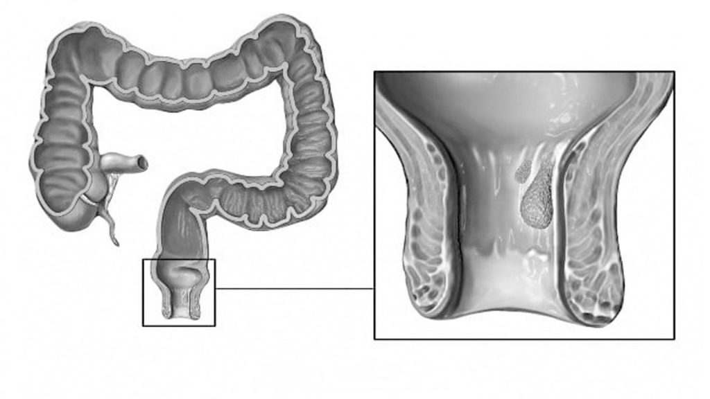 Hemoroid Nedir