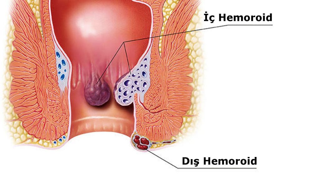 hemoroid ameliyatı nedir