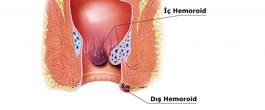 hemoroid kanaması